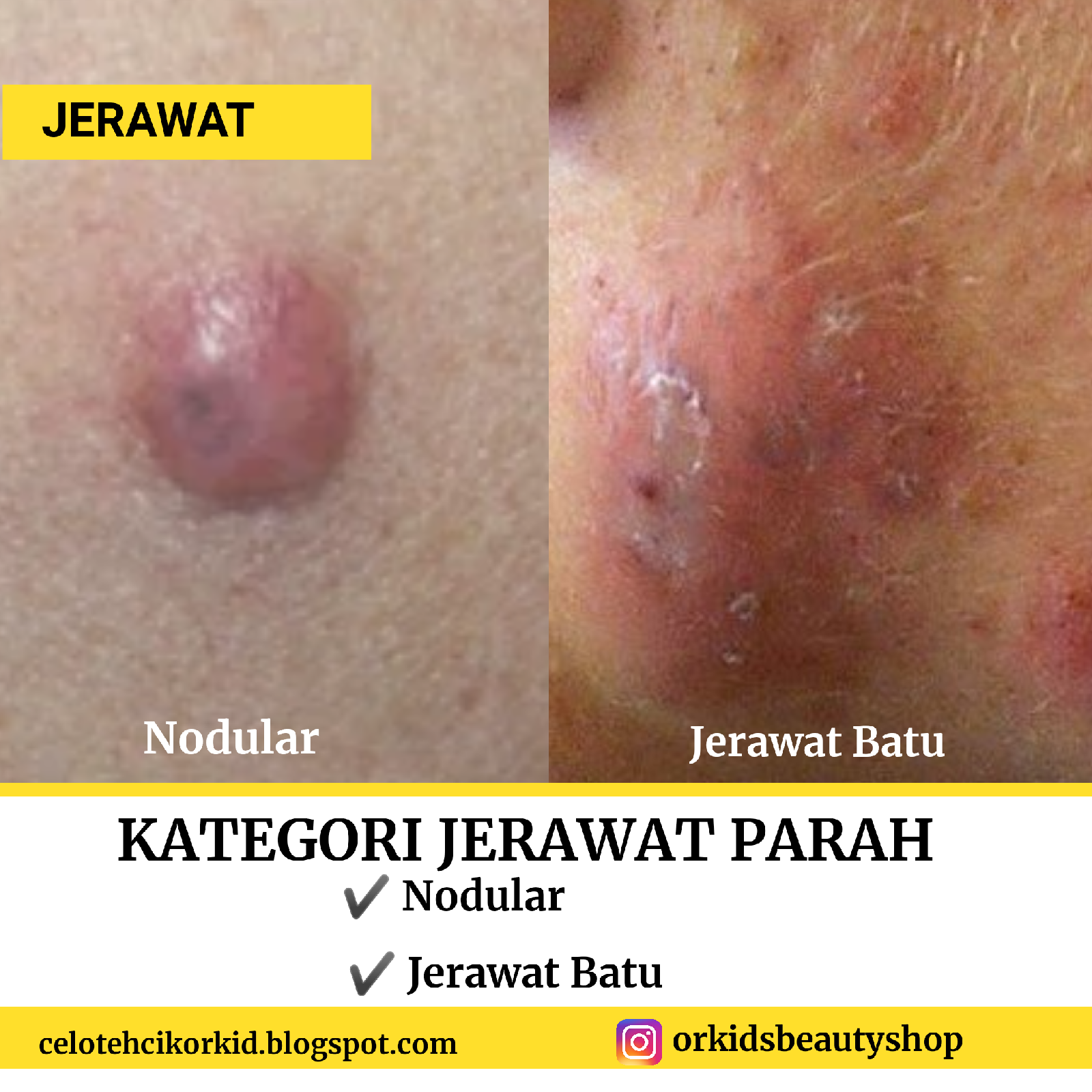 Jerawat: Cara Pantas Hilangkan untuk Kulit Bebas Cela