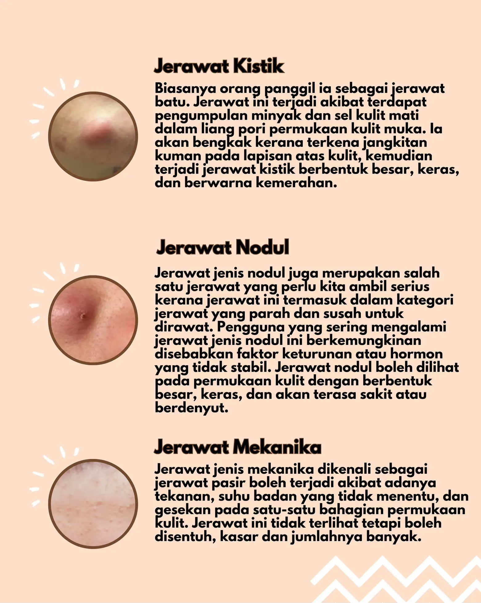 Jerawat: 11 Cara untuk Hasil Terbaik